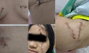 Mulher tem seios e rosto cortados a bisturi por ex-amante do marido ao sair de academia