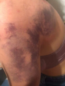 Justiça solta homem que espancou filha em Garanhuns, mas concede medida protetiva à vítima