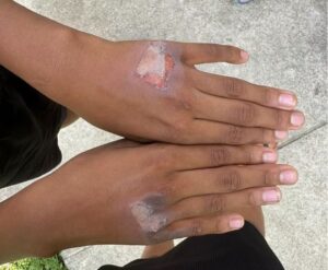 Mulher suspeita de queimar as mãos do próprio filho com chapinha de cabelo