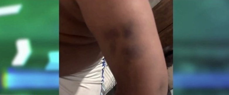 Adolescente de 13 anos é agredido dentro de escola municipal em Jaboatão e passa por cirurgia